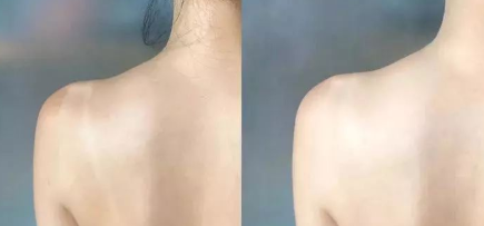打美白针价格大概是多少