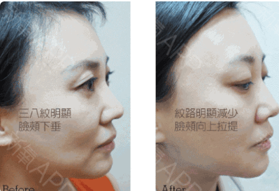 超声刀美容单次价格？