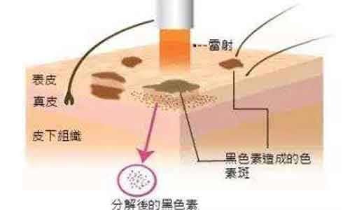 激光去斑的利弊分别是什么？