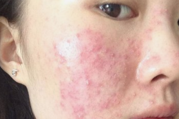 脸上长了闭合性粉刺，可能是内分泌出现问题了吗？