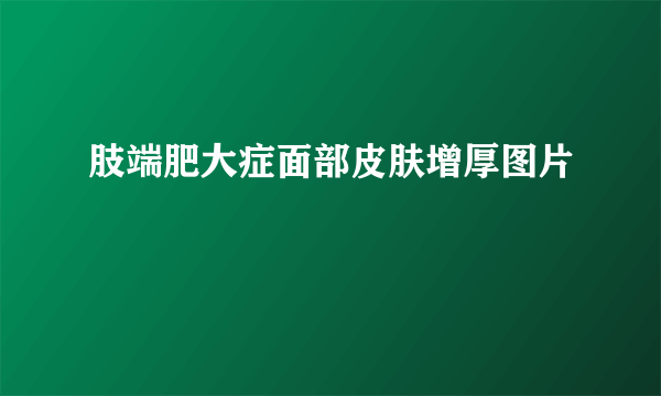 肢端肥大症面部皮肤增厚图片