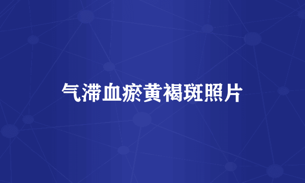 气滞血瘀黄褐斑照片
