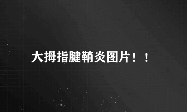 大拇指腱鞘炎图片！！