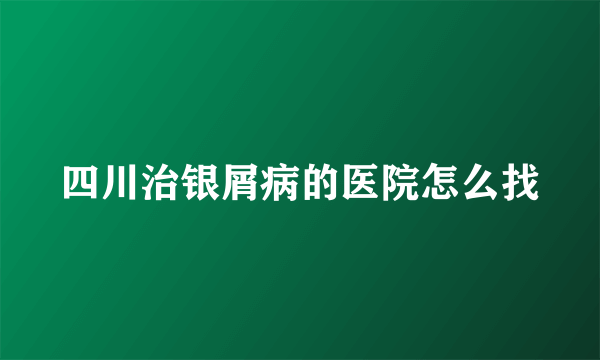 四川治银屑病的医院怎么找