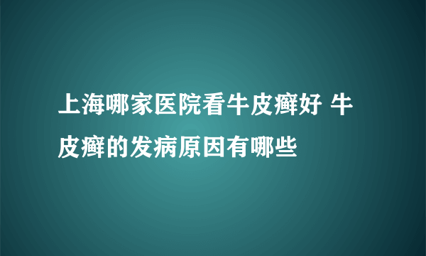 上海哪家医院看牛皮癣好 牛皮癣的发病原因有哪些