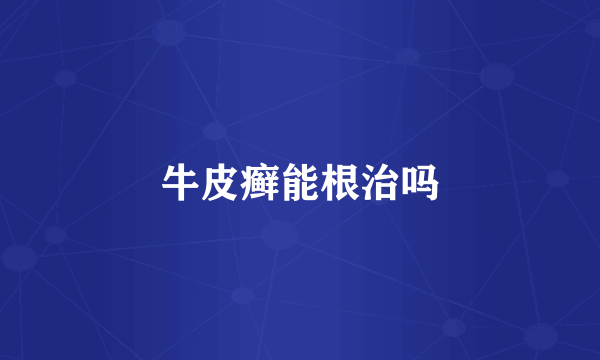 牛皮癣能根治吗